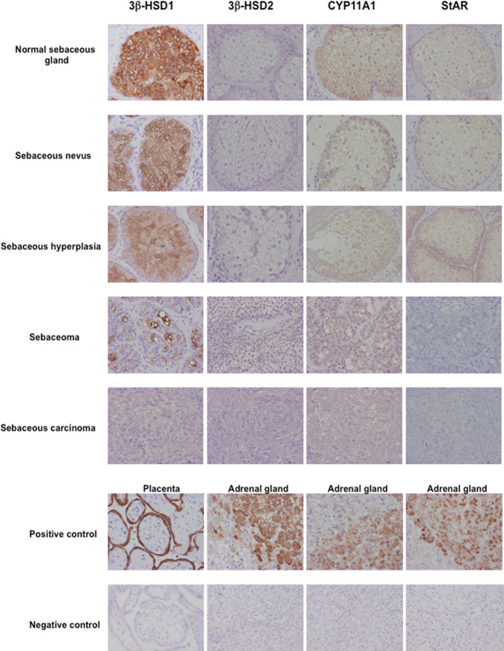 Representative illustration of 3β-hydroxysteroid dehydrogenase (3β-HSD) 1, 3β-HSD2, cytochrome P45011A1 (CYP11A1) and steroidogenic acute regulatory protein (StAR) in human sebaceous gland and its disorders. Marked cytoplasmic 3β-HSD1, CYP11A1 and StAR immunoreactivity was abundant in normal sebaceous glands and weak in pathological sebaceous glands (magnification 200x).