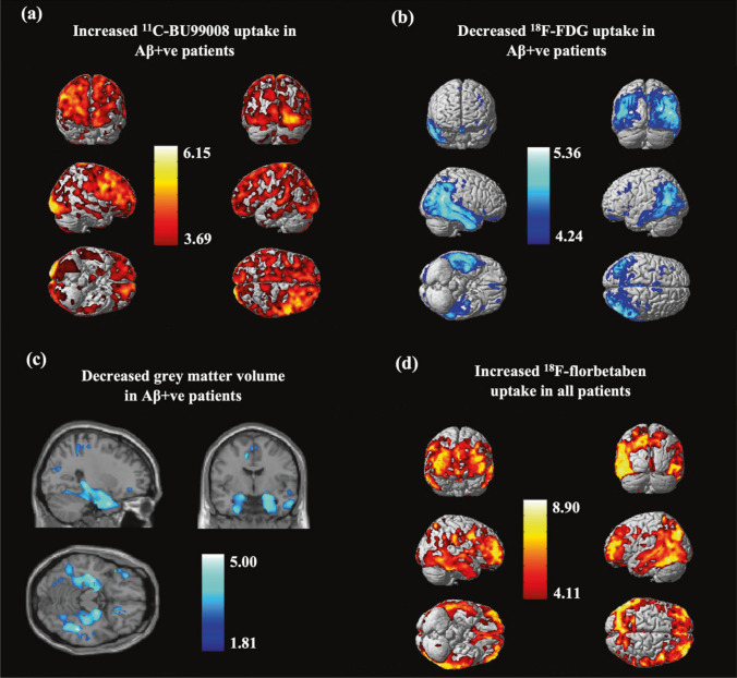 Relationship between [11C]BU99008, [18F]FDG, gray matter volume and [18F]florbetaben in AD patients. This research was originally published in Mol Psychiatry. Livingston NR, Calsolaro V, Hinz R, Nowell J, Raza S, Gentleman S, et al. Relationship between astrocyte reactivity, using novel 11C-BU99008 PET, and glucose metabolism, grey matter volume and amyloid load in cognitively impaired individuals. Mol Psychiatry. 2022;27:2019-29. http://creativecommons.org/licenses/by/4.0/