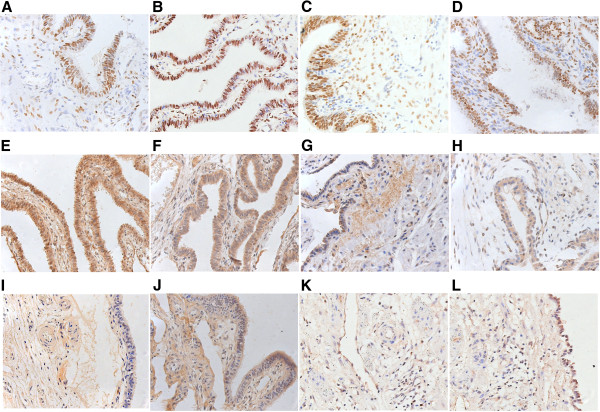Immunostaining of the implantation site in the fallopian tube in tubal pregnancy. Representative images showing immunoreactivity of estrogen receptor (ER)-alpha (A, B), progestogen receptor (PR) (C, D), leukemia inhibitory factor (LIF) (E, F), vascular endothelial growth factor (VEGF) (G, H), inducible nitric oxide synthase (iNOS) (I, J), and endocannabinoid receptor (CB1) (K, L). Positive immunolabeling was detected in the epithelial and stromal cells from both the LNG-EC group (A, C, E, G, I) and the control group (B, D, F, H, J). The immunostaining for ER-alpha (A, B) and PR (C, D) was observed in the nuclei of the epithelial and stromal cells from both groups. The positive staining for LIF (E, F), VEGF (G, H), iNOS (I, J), and CB1 (K, L) was found in the cytoplasm of the epithelial and stromal cells from both groups. No significant differences were observed in any of the immunoreactivity of ER-alpha (A, B), PR (C, D), LIF (E, F), VEGF (G, H), iNOS (I, J), or CB1 (K, L) between the two groups. Magnification: 400×.