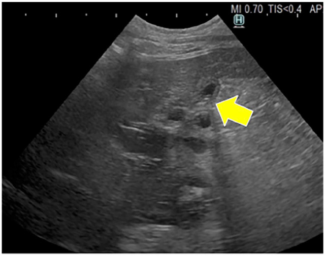 Ultrasonographic image of the liver and intrahepatic and extrahepatic bile ducts 2 days postoperatively. The intrahepatic and extrahepatic bile ducts were not dilated (yellow arrow). No ascites or bile leakage from the surgical site was observed
