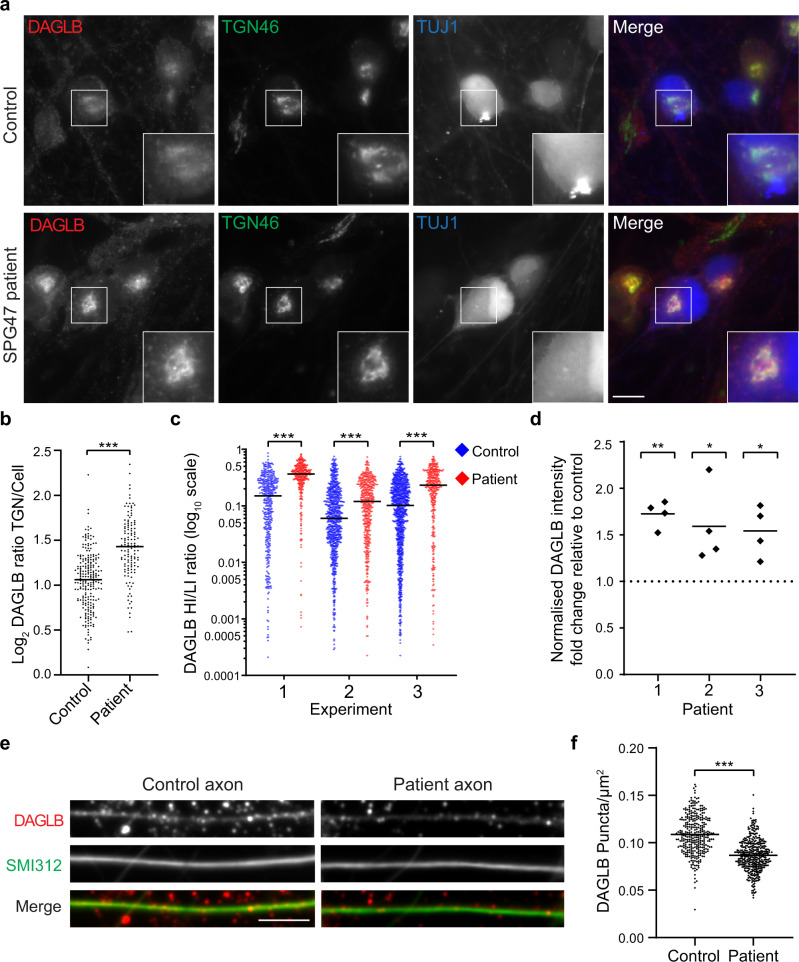 DAGLB is missorted in iPSC-derived cortical neurons from AP-4-deficient patients.iPSCs from patients with AP4B1-associated AP-4 deficiency syndrome (SPG47) and their unaffected same sex heterozygous parents (control) were differentiated into cortical neurons. a Widefield imaging of immunofluorescence triple labelling of DAGLB (red), TGN46 (green) and TUJ1 (a marker to distinguish neurons from co-cultured astrocytes; blue) in iPSC neurons from patient 1 and their matched control. DAGLB signal was increased at the trans-Golgi network (TGN) in the AP-4 patient cells. Scale bar: 10 μm. b Quantification of the ratio of DAGLB labelling intensity between the TGN and the rest of the cell, in the cells shown in (a). The experiment was performed in technical triplicate and the graph shows combined replicate data: each datapoint indicates the log2 ratio for an individual cell (horizontal bar indicates median; n = 227 cells for control; n = 129 cells for patient). Data were subjected to a two-tailed Mann–Whitney U-test: ***p ≤ 0.001 (p = 6.7 × 10−20). c High-throughput confocal imaging was used to assay the distribution of DAGLB in iPSC-derived neurons from patient 1 and their matched control. Neurons in 96-well plates were labelled with antibodies against DAGLB, GOLGA1 (a TGN marker) and TUJ1. The ratio between the area of high intensity (HI; overlaps with TGN) and low intensity (LI) DAGLB labelling was quantified from three differentiations per cell line (biological triplicate; plotted separately): each datapoint indicates the ratio for an individual cell, plotted on a log10 scale (horizontal bar indicates median; experiment 1/2/3: n = 417/786/999 cells for control; n = 306/464/339 cells for patient). Data were subjected to a two-tailed Mann–Whitney U-test for comparison of the patient and control within each differentiation: ***p ≤ 0.001 (1: p = 2.4 × 10−37; 2: p = 7.2 × 10−10; 3: p = 3.2 × 10−23). Comparable results for another SPG47 patient (patient 2) are shown in Supplementary Fig. 5b. d Western blotting was used to quantify the level of DAGLB in whole-cell lysates from iPSC-derived neurons from three patients with SPG47 and their unaffected same sex heterozygous parents. Data are from n = 4 differentiations per cell line, and the graph shows fold change in normalised DAGLB intensity in the patient relative to control (horizontal bars indicate mean). Log-transformed absolute normalised intensity values were subjected to a two-tailed paired t test for comparison of each patient with their matched control: **p ≤ 0.01; *p ≤ 0.05 (1: p = 0.001; 2; p = 0.036; 3: p = 0.019). e High-throughput confocal imaging was used to assay the density of DAGLB puncta in axons of iPSC neurons from patient 1 and their matched control. Representative images are shown of anti-DAGLB (red) in axons marked with the axonal marker antibody cocktail SMI312 (green). Scale bar: 10 μm. f Quantification of the number of DAGLB puncta per area (µm2) in axons from patient 1 and their matched control, from high-throughput confocal images as shown in (e). Each datapoint represents the mean number of DAGLB puncta per axon area per image (n = 324 images in the control group and n = 405 images in the patient group, covering 21902 and 25253 axon segments respectively). Data were subjected to a two-tailed unpaired t test: ***p ≤ 0.001 (p = 3.7 × 10−50). Source data are provided as a Source Data file.