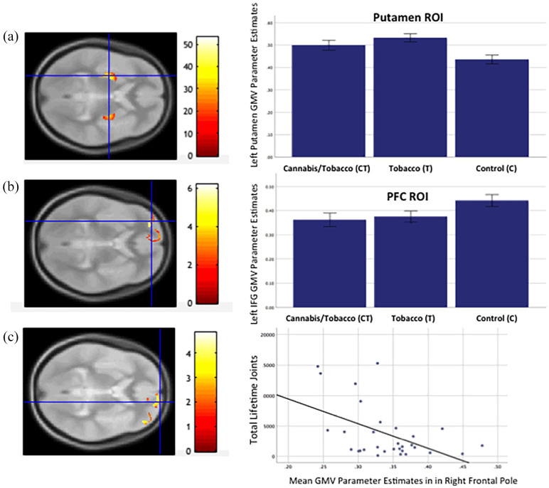 (a) SPM showing Group effect (axial orientation) in bilateral putamen ROI (CT > C) and left putamen (T > C) (p = 0.0001 unc. for illustration). Bar chart shows GMV parameter estimates by group in putamen peak. (b) SPM showing Group effect (axial orientation) in bilateral PFC ROI (CT and T > C) in left inferior frontal (CT > C) (p = 0.001 unc. for illustration). Bar chart shows GMV parameter estimates by group in left inferior frontal gyrus. (c) SPM showing Group effect (axial orientation) in bilateral PFC ROI (CT > C) and right frontal pole (CT > C) (p = 0.001 unc. for illustration). Scatterplot showing right frontal pole parameter estimates against total lifetime joints in the CT group.GMV: grey matter volume; PFC: prefrontal cortex; ROI: region of interest.