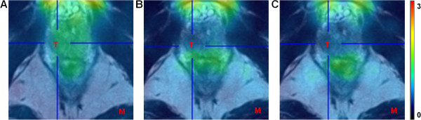 PET/MRI imaging in locally confined PCa. PET/MRI fusion image of the first (A), second (B) and third (C) acquisition time interval in a representative patient (patient 4). The uptake of 18F-MK-9470 in the local tumour is comparable to the uptake in the surrounding healthy prostatic tissue. T, tumour; M, muscle. Data are scaled from 0 to 3 SUV.