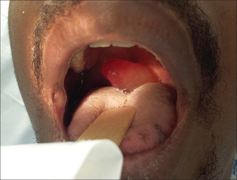 Photograph demonstrating uvular edema