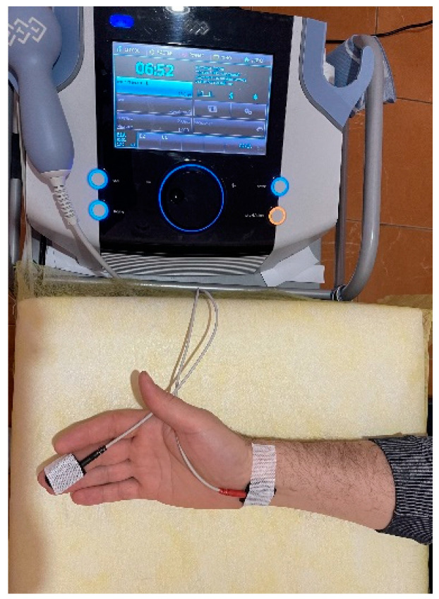 Stimulation of the median nerve by low-frequency, high-amplitude transcutaneous electrical nerve stimulation. The cathode was fixed over the carpal tunnel, and the anode was fixed on the palm distal to the middle finger.