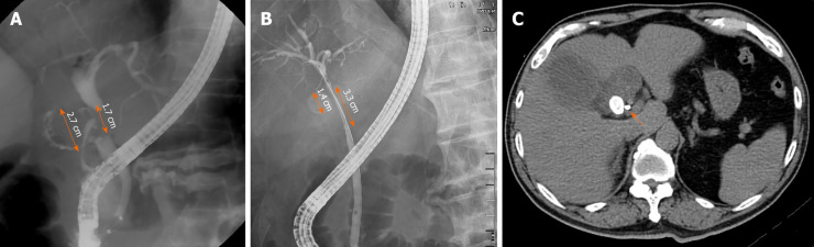 Stricture length in common bile duct in patients with Mirizzi syndrome. A: One 2.7-cm gall bladder stone caused a cholecystocholedochal fistula. The stricture length is only 1.7 cm, which is less than the actual size of the stone; B and C: One 1.4-cm gall bladder stone compressed the common bile duct. However, the stricture of common bile duct is 3.3 cm in length. Computerized tomography after endoscopic retrograde cholangiopancreatography revealed that the plastic biliary stent was close to the stone (orange arrow).