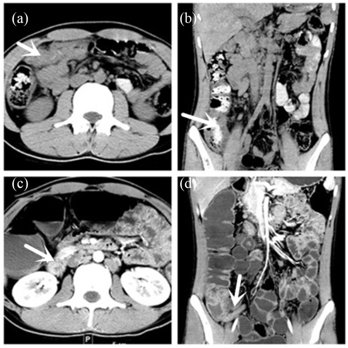 CT and CTE showed multiple segmental thickening of the intestinal wall.
