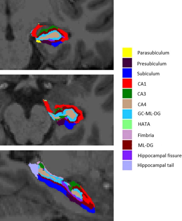 Cross-sectional slices of a T1-weighted image from one participant with automated segmentation of hippocampal subfields overlaid. Coronal (top), axial (middle), and sagittal (bottom) views. CA, cornu ammonis; GC-ML-DG, granule cells in the molecular layer of the dentate gyrus; HATA, hippocampal-amygdala transition area; ML-DG, molecular layer of the dentate gyrus.