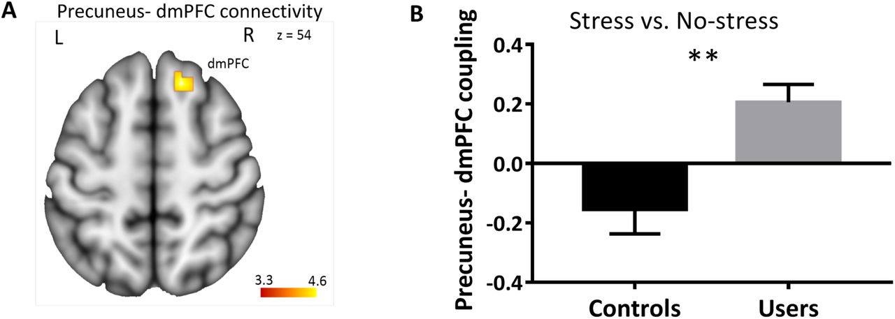 Cannabis users exhibited increased functional connectivity between the precuneus (seed region) and the dorsal medial prefrontal cortex (dmPFC) during stress. (A) Location of the precuneus-dmPFC pathway that exhibited group differences, (B) extracted connectivity estimates from the pathway for the contrast (stress > no-stress). Image is thresholded at p < 0.001, uncorrected. Error bars reflect the SEM. **p < 0.01. Laterality [left (L), right (R)].