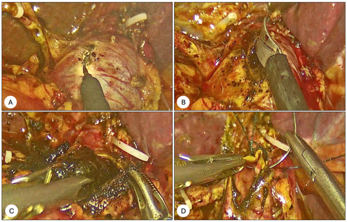 Intraoperative findings in the case of laparoscopic commom bile duct exploration (LCBDE). (A). Common Bile Duct (CBD) enlarged. (B). Opening CBD for clearance. (C) Clearance of CBD. (D) Suturing CBD with 3/0 barbed suture.