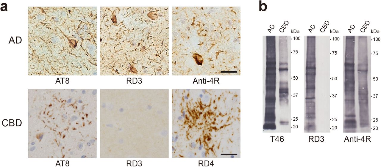 Imunohistochemistry and immunoblotting of AD and CBD cases.a. Immunostaining of sections from occipital cortex of the Alzheimer’s disease case and putamen of the corticobasal dewgeneration case using anti-tau antibodies AT8, RD3, Anti-4R and RD4. Scale bar, 25 mm.b. Immunoblotting of sarkosyl-insoluble fractions from occipital cortex of the Alzheimer’s disease case and putamen of the corticobasal degeneration case using anti-tau antibodies T46, RD3 and Anti-4R.