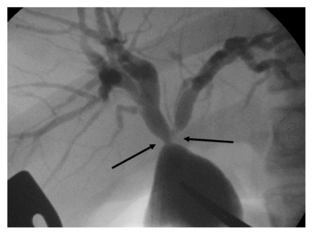 Stenosis of hilar hepatic duct (black arrow) was confirmed on intraoperative cholangiography during re-operation.