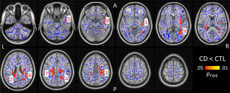 Group differences in white matter microstructure. Two-sample t test results showing regions with significantly lower fractional anisotropy in the CD group relative to CTL. Significant clusters are highlighted in red and are overlaid on the group mean white matter skeleton in blue. Numbers correspond to the “cluster number” column in Table 1. L left, R right, A anterior, P posterior, CD cannabis dependence, CTL controls