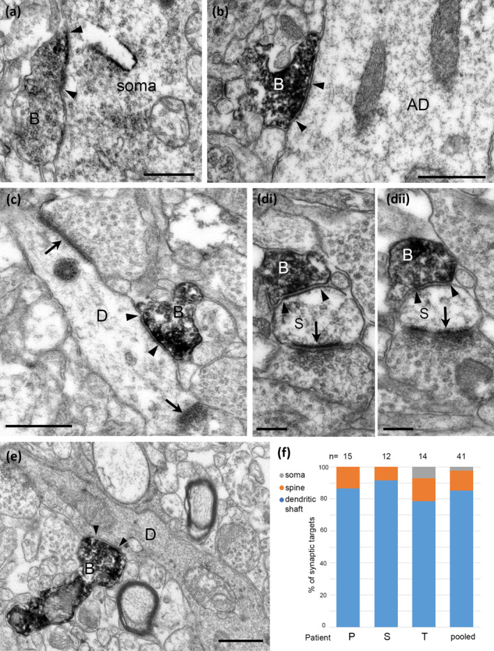 Electron micrographs of the synaptic targets and quantitative distribution of VGLUT3 expressing nerve terminals forming type‐2 synapses. Immunoperoxidase reactions show VGLUT3‐positive terminal boutons (B) filled with electron‐opaque DAB‐deposit (black); the synaptic junctions are marked by arrowheads. (a) A neuronal soma receives a type‐2 synapse from VGLUT3‐positive bouton. (b) A large apical dendrite (AD) as postsynaptic target. (c) A small diameter dendritic shaft (D) receives two type‐1 synapses (arrows) in addition to the synapse from a VGLUT3‐positive terminal and it likely originates from an interneuron. (di, dii) Serial sections of a dendritic spine (S) receiving a type‐2 synapse from the VGLUT3‐positive bouton and a type‐1 synapse (arrow) from an unlabelled bouton. (e) A small diameter dendritic shaft (D) with electron opaque cytoplasm is innervated by a VGLUT3‐positive terminal. (f) Quantification showing that most of the synaptic targets of type‐2 synapses were dendritic shafts and far fewer were dendritic spines in samples from three patients. Scale bars: (a–c, e) 0.5 μm; (d), 0.2 μm.