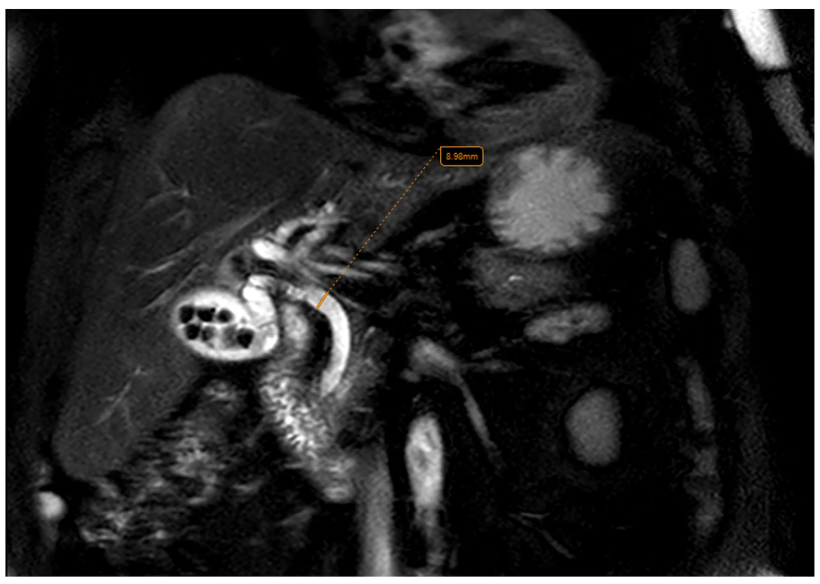 Coronal T2-weighted image illustrating CBD diameter measurement.