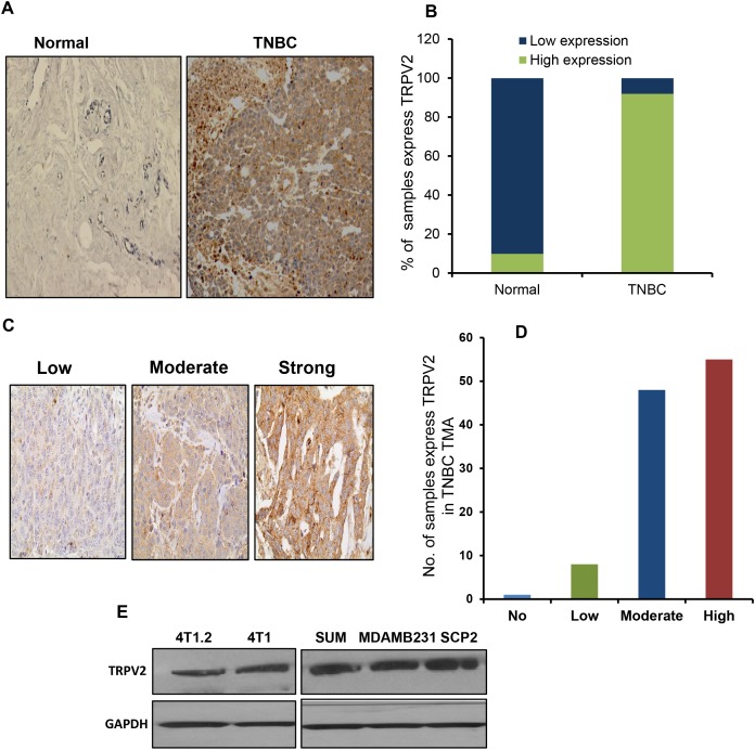 TRPV2 is highly expressed in TNBC tissues and associated with better prognosisA. Representative image of immune-histochemical (IHC) staining showing TRPV2 expression in normal and TNBC breast tissues. B. Quantitation of TRPV2 expression of normal and TNBC breast tissues. C. Representative image of IHC staining showing different grades of TRPV2 expression in the tissue microarray (TMA) of TNBC patient samples that has been used in the study. D. Quantitation of TRPV2 expression in the tissue microarray (TMA) of TNBC patient samples that has been used in the study. E. Western blot image showing TRPV2 protein expression of 4T1.2, 4T1, SUM159, MDA-MB231 and SCP2 breast cancer cell lines. GAPDH has been used as a loading control. F. Tissue microarray analysis showing the recurrence free survival (RFS) of TNBC patients (n=116) of high/low TRPV2 protein expression.G. Kaplan Meier blot showing RFS of high/ low expressing TRPV2 breast cancer patients of basal subtypes (n= 580 patients). P values are provided for each Kaplan Meier graph.