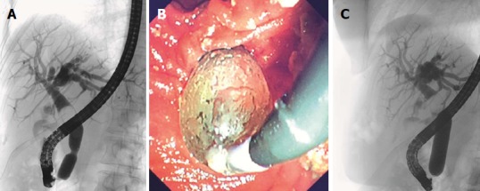 Demonstration of endoscopic papillary large balloon dilatation. A: Fluoroscopic view showing balloon waist with a proximal stone; B: Endoscopic view of ampullary orifice while performing EPLBD; C: Demonstration of disappearance of balloon waist with gradual inflation of balloon.
