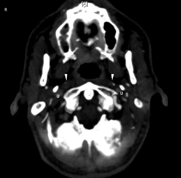 CT angiography of the head with 125 mL Optiray 350 contrast, with white arrowheads showing the ICA occlusions with calcification. IJ: internal jugular.