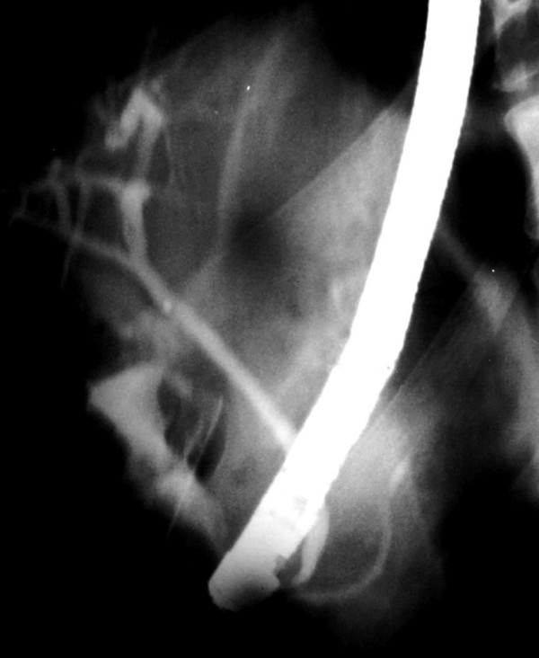 Cholangiography of a case without dilation in CBD. CBD and PD in normal diameter entering to the duodenal bulb separately. The hook – shape and tapering of the distal end of the CBD is now slightly perceived when it's in normal diameter