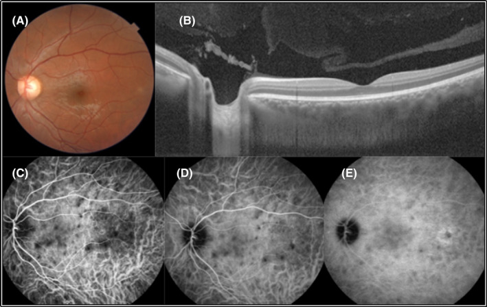 Multimodal imaging of the LE. No SRF is apparent in fundus photograph (A) and B‐scan OCT (B) of the patient. Multiple hypocyanescence dark dots, and enlarged and fuzzy choroidal blood vessels are visible in ICGA (C–E).