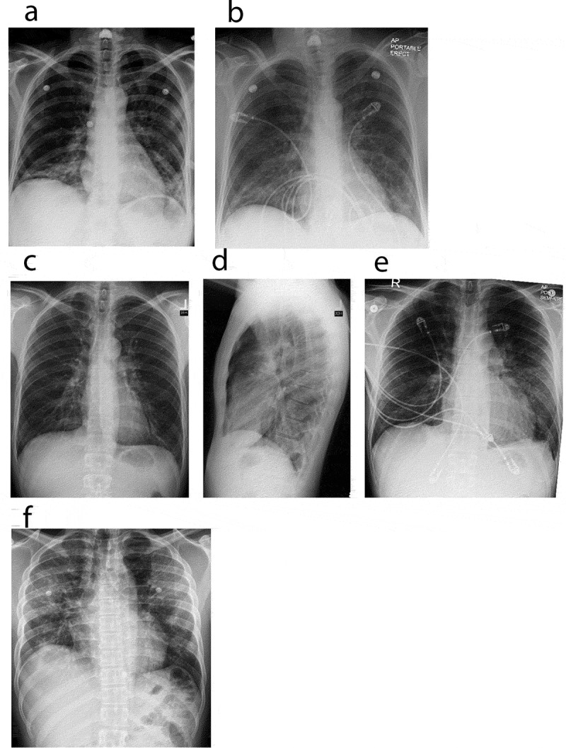 Chest X ray. Chest radiographs depicting a spectrum of EVALI. (a) and (b) Chest radiographs of case 1. (a) (Day 1 of admission, pre-treatment), revealed bi-basilar haziness whereas (b) (steroid day 2), demonstrated mild improvement of left lower lobe infiltrates. (c–e) Chest radiographs of case 2. (c, d) (Day 1 of admission, pre-treatment), revealed minimal infiltrates bilaterally. Punctate density of the left upper chest is suggestive of a calcified granuloma (c), with lateral view (d) showing minimal infiltrate. (e) (steroid day 3), demonstrates clinical improvement in bilateral infiltrates. (f) Chest radiograph of case 3. (f) (Day 1 of admission, pre-treatment), revealed patchy infiltrates bilaterally