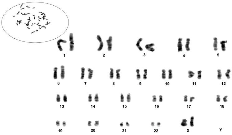 G-banded karyotype analysis of the H8T-MG meningioma culture. Representative metaphase spread showing a normal distribution of chromosomes without visible fragmentation or gross structural abnormalities. Ordered karyotype obtained from G-banded metaphases, confirming the absence of major numerical or structural chromosomal alterations in H8T-MG cells.