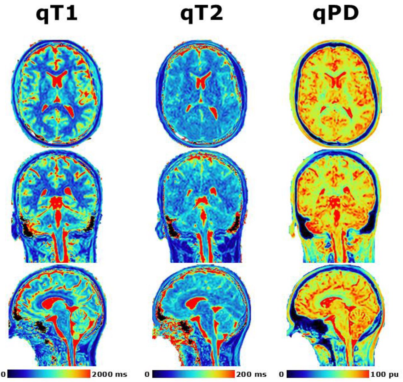 Demonstration of post-processing available from SyMRI combined with 3D-QALAS at high isotropic resolution in a healthy volunteer. Shown are the quantitative T1 (left), quantitative T2 (middle), and quantitative PD (right) in the axial (top), coronal (middle), and sagittal (bottom) orientations.