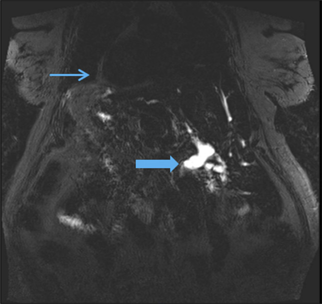 Coronal MRI demonstrates markedly dilated CBD with distal tapering and abrupt cutoff of the CBD with multiple filling defects (thick arrow). Situs inversus and dextrocardia (thin arrow) are seen. CBD, common bile duct; MRI, magnetic resonance imaging.