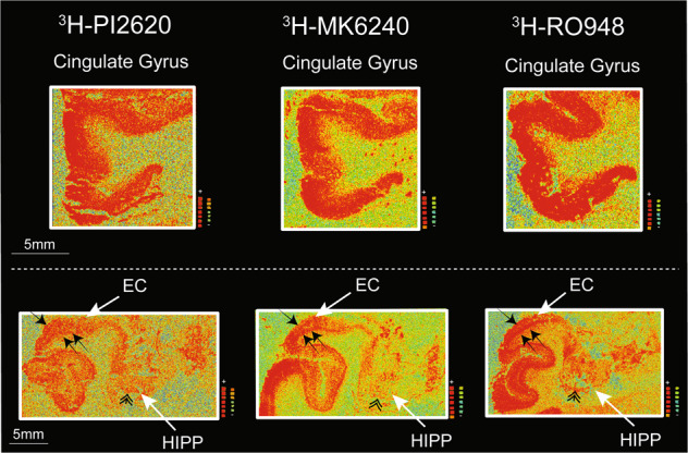 3H-PI2620, 3H-MK6240 and 3H-RO948 autoradiography binding comparison in different layers of distinct cortical regions of large frozen adjacent hemispherical brain sections from a patient with sporadic AD.Autoradiography images are extracted from Fig. 3. Only the total binding for the three tracers in different regions of interest (ROI) is shown. The white arrows indicate the ROI. The small black single arrow indicates the superficial layers of the cortex, the small black double arrows indicate the deep layers of the cortex and the double arrowhead indicate the hippocampal CA1 region. AD Alzheimer’s disease, EC entorhinal cortex, FC frontal cortex, FG fusiform gyrus/lateral occipitotemporal gyrus, HIPP hippocampus.
