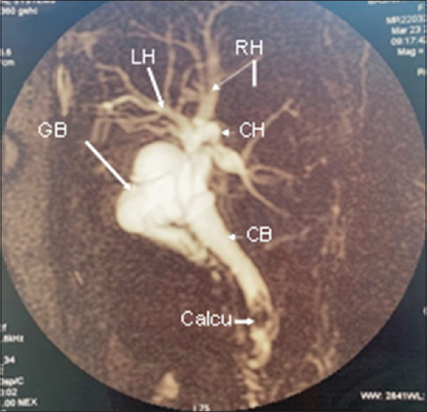 Magnetic resonance cholangiopancreatography showing a gall bladder remnant with calculi, as well as calculi in the distal common bile duct. LHD: Left hepatic duct; CHD: Common hepatic duct; RHD: Right hepatic duct, GB: Gall bladder