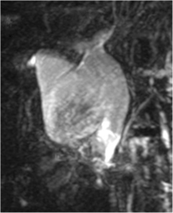 Magnetic resonance cholangiopancreatography demonstrated a cystic dilatation of the extrahepatic bile duct (Todani’s CBD classification: type 4-A)