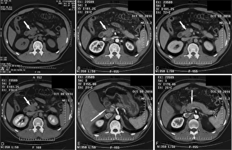 Abdominal CT demonstrates a low-density mass measuring 3.5 × 3.2 cm in the uncinate process of the pancreas, with dilated common bile and pancreatic ducts. (A) to (D) represent the plain phase, arterial phase, portal phase, and venous phase, respectively. (E) shows the dilated bile duct, and (F) reveals the dilated pancreatic duct.