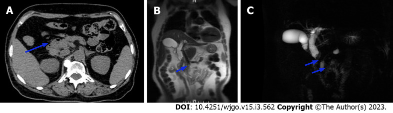 Imaging revealed an occupying lesion of the middle segment of the common bile duct. A: Computed tomography showed localized thickening with iso-low signal nodules in the middle part of the common bile duct (CBD), approximately 12 mm × 13 mm in size. The nodules were significantly enhanced heterogeneously; B and C: Magnetic resonance imaging by the (B) coronal plane FIESTA sequence and (C) magnetic resonance cholangiopancreatography revealed dilation of the intrahepatic duct and CBD, a soft tissue mass signal at the lower end of the CBD (with rough edge), limited diffusion on weighted imaging, and low signal intensity on apparent diffusion coefficient mapping.