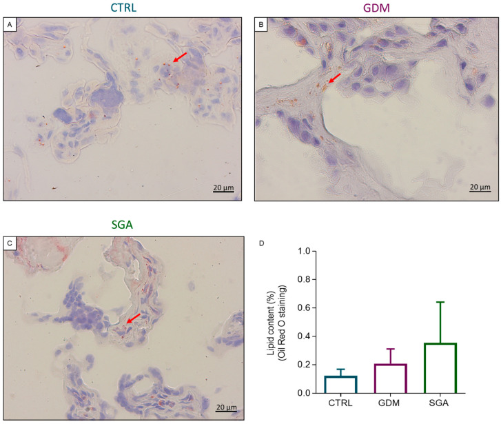 Lipid content analysis through histology in the three experimental groups. Representative histological images showing the lipid droplets (red arrows) within the CV sections (A–C). Analysis of lipid content in CV sections using Oil Red O staining (D). Bars represent lipid content in the three conditions expressed as mean ± SD of five independent samples (n = 5). CTRL: control group (blue), GDM: gestational diabetes mellitus (purple), SGA: small-for-gestational-age (green).