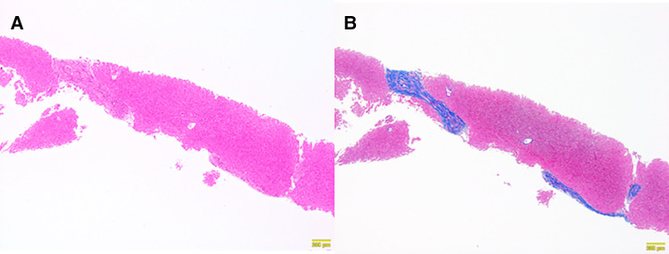 Histopathological findings of a needle liver biopsy specimen obtained six months later. Chronic hepatitis and fibrosis, F2–3, A1. (A) Persistent portal area enlargement was observed. The inflammatory findings had improved (Hematoxylin Eosin staining ×10). (B) Persistent bridging fibrosis was observed (AZAN staining ×10).