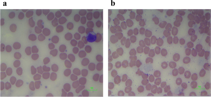 a Blood film of cells exposed to 100 ng/ml cannabidiol (CBD). Blood film showing red cell changes in 100 ng/ml CBD: red cell membrane distortion/indentation with occasional red cell fragments. Scale = 100 μm. b Blood film of cells exposed to 100 ng/ml delta-9-tetrahydrocannabinol (THC). Blood film showing red cell changes in 100 ng/ml THC: red cell fragmentation, burr cells. Scale = 100 μm