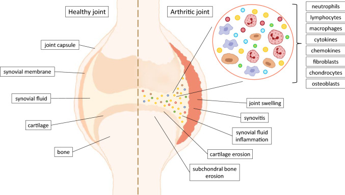 Schematic summary of arthritis pathogenesis. Pathological changes, such as swelling, synovial membrane outgrowth and inflammation (synovitis), are observed in both OA- and RA-affected joints. Although the inflammatory state is an important factor in the development of OA, it is not as critical as in RA, which is a typical inflammatory disease. In the synovial fluid, several inflammatory factors, such as cytokines, chemokines, macrophages, neutrophils, fibroblasts, chondrocytes and osteoblasts, can be found. Gradual cartilage degeneration, which is characteristic of OA progression, causes bone exposure and pain, while released cartilage fragments potentiate synovitis within the joint capsule