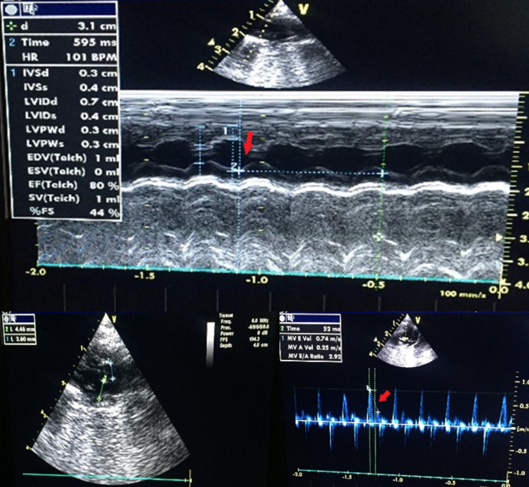 M-mode (top) and two-dimensional (left bottom) echocardiographic images and Doppler tissue images (right bottom) of the left ventricle in Control group. IVSd interventricular septal end diastole, IVSs interventricular septal end systole, LVIDd left ventricular internal diameter end diastole, LVIDs left ventricular internal diameter end systole, LVPWd left ventricular posterior wall thickness in diastole, LVPWs left ventricular posterior wall thickness in systole, EDV end-diastolic volume, ESV end-systolic volume, EF ejection fraction, SV stroke volume, FS fractional shortening, MV E Vol mitral valve flow E-wave, MV A Vol mitral valve flow A-wave
