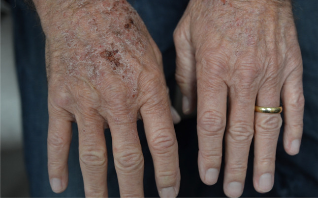 Pirfenidone phototoxic drug eruption
